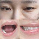 휴성심병원급 의료기관 | 힐로웨이브 브이올렛 이상증상 후기❤ 대구성형외과 피부과 ㅣ 신부관리 직전에 시술하지말자❤