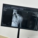 BYC | 6살 아기 낙상으로 팔뼈 골절 반깁스 통깁스 안됨 ; 휴 (아기팔골절, 아기골절, 아기뼈부러짐, 아기낙상)