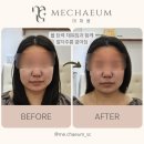 4669 | 송파 두피관리 두피열 내리고 얼굴 볼륨까지 채워준 미채움 헤드스파 후기