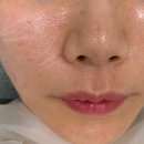 포텐자 모공팁과 쥬베룩 스킨 받은 피부과 시술 후기