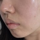 송파아쿠아 | 방이동에스테틱 데자뷰메디스킨 잠실점 | 30대 모공&피지 아쿠아필 후기