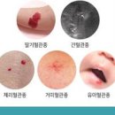 &#39;유아 혈관종&#39; 원인 / 증상 / 치료 혈관이 뭉쳐있는 덩어리 붉은 반점 이미지