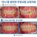 닥터홍스치과의원 | 덧니 교정 과정, 기간, 후기 총정리｜비발치 교정치료 가능할까?