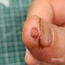 영보약국 | 🩹 엄지손가락 부상… 케어리브 손끝용 멸균 반창고로 케어했어요!