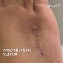 공지로 | [공지] 발가락 단지증 수술후기(5) (장치제거 후 일상)