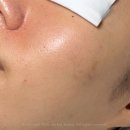 제이라운지 에스테틱 | 천호피부관리 제이라운지 에스테틱에서 골드필 받고 매끈한 피부 만든 후기