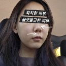 약초명가&스킨케어 | 천안 피부관리 추천 백석동 여드름 흉터 케어 이정희 스킨케어 약초필링 후기