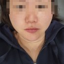 삼성2-120 | 올리디아 삼성역피부과 : 올리디아스킨 120 콜라겐주사 후기