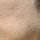 더 메디스파 | 부평피부관리 내돈내산 브이메디스파 블루필 후기