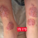 피부야숨쉬자 | 13세 여아.. 심한 피부를 자연치유...