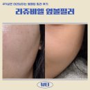 정풍 | 신논혁역 필러5살은 어려보이는 리쥬비엘 옆볼필러 후기