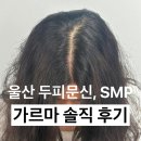 진성화학 | 울산 두피문신 솔직 후기｜울산 멜 smp 가르마 탈모 커버 충격 후기