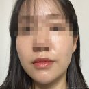 [공지] 범어 피부관리샵 내돈내산 후기 ' 린앤스킨 ' - 여드름 압출 추천 (좁쌀 여드름 타파 후기)