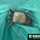 범플란트치과의원 네이버블로그