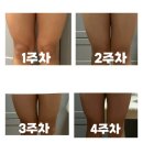 삼성4차 | 삼성역피부과 허벅지지방분해주사 4차 내돈내산 후기