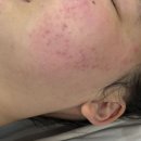 서면 여드름 관리 오비아 에스테틱에서 사춘기 트러블 탈출하기