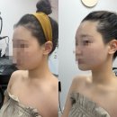 트윈(twin)아름뷰티 | 대구알테온윤곽관리 널위한뷰티 1회만으로 이중턱 완전 소멸