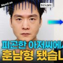 11650-1-10-584 | 남자 하안검 수술 한 달 후기 브이로그📺 | 피곤한 아저씨에서 10년 젊어진 얼굴로!