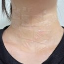 지웰약국 | 청주 하늘체한의원 편평사마귀 비립종 저렴하게 제거한 후기 1탄