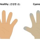 청색증[cyanosis] 이미지