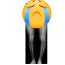 평안의원.한의원 | | 2026년 4월 9일 수술 | 근위경골절골술(휜다리 수술) | 양천구 "뉴본정형외과" 에서