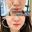대우땅콩 | 해운대리프팅 추천 페이슬림 알테온리프팅 꺼진옆볼 볼륨윤곽 관리 후기