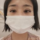 다스림한의원 | 쌍수 자연유착 붓기 기록, 실밥 제거 통증과 세수 가능 시기 총정리(아이씰패치 내돈내산)