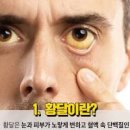 눈이 노랗게 이유는? 성인 황달 포함 눈 흰자 노란색 원인 4가지 이미지