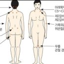 섬유근육통 이미지