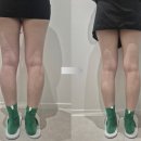 자동차피부과 | 강남역피부과 리쥬엘 온다레이저 리프팅 다리 시술 후기.
