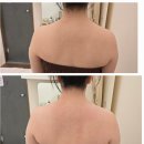 에덴케어 | 안산바디 봄 스킨&amp;바디(구 에덴스킨케어) 승모근 관리 후기