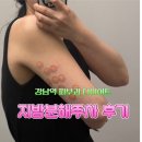 (주)고려텍미디어 | 강남역 피부과 다이어트 | 팻듀스 팔뚝 지방분해주사 24cc 후기
