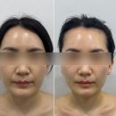문희피부관리실 | 율에스테틱 올티모 리프팅 관리 후기