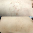 국민건강보험공단일산병원 노동조합 | 일산 등여드름흉터 관리｜정발산역·라페스타·마두·백석·주엽 실제 케이스