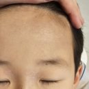 아토피 한의원 치료 탈스 기록 두달치