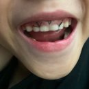 대성치과의원 | 치카푸카 6세 매복 과잉치 발치 진정치료와 웃음가스후 수술 대성공적