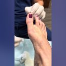 Aspiration of a cyst in the foot 이미지