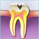 치과질환 1위 충치, 치료방법에 대해 설명드립니다. 이미지