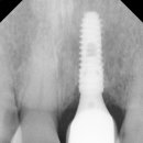 정담치과의원 | 타치과 임플란트 보철 탈락… 왜 반복될까? 나주 정담플란트 해결 후기 2케이스