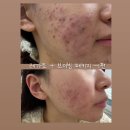 여드름 치료 4 | 레가토 레이저•브이빔 패키지 1회차 후기 이소티논•야즈