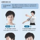 뇌졸중 이미지