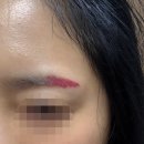 엘드림한방병원 | 문신제거 병원 피코웨이 레이저 후기 붉어진 잔흔 몇...지웠어요 통증 다운타임 효과 모든걸 알려드림