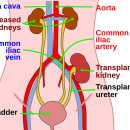 신장 이식[kidney transplantation] 이미지