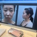 필업100 | 압구정 성형외과 필업 볼륨콜라겐 앞볼꺼짐 효과대박 앞볼생성 찐 후기