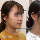 동한의원 | 측두근 보톡스 부작용 후기, 솔직히 이럴 줄 몰랐어요