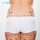 미와모의원 | 청주지방흡입 원하는 부위만 골라서 다이어트 하기?!