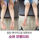에이치드림정형외과의원 | 소아 안짱다리, 자연적으로 좋아질까? 원인부터 교정 시기까지 4가지