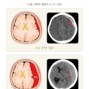 뇌내촐혈[ICH, intracerebral hemorrhage] 이미지