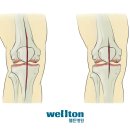 [무릎인공관절] 무릎인공관절 최소절개술 이미지