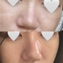 삼성밸런스의원 | 얀의원 코조각주사 내돈내산, 콧볼보톡스 후기 • 통증 • 효과 👍🏻✨